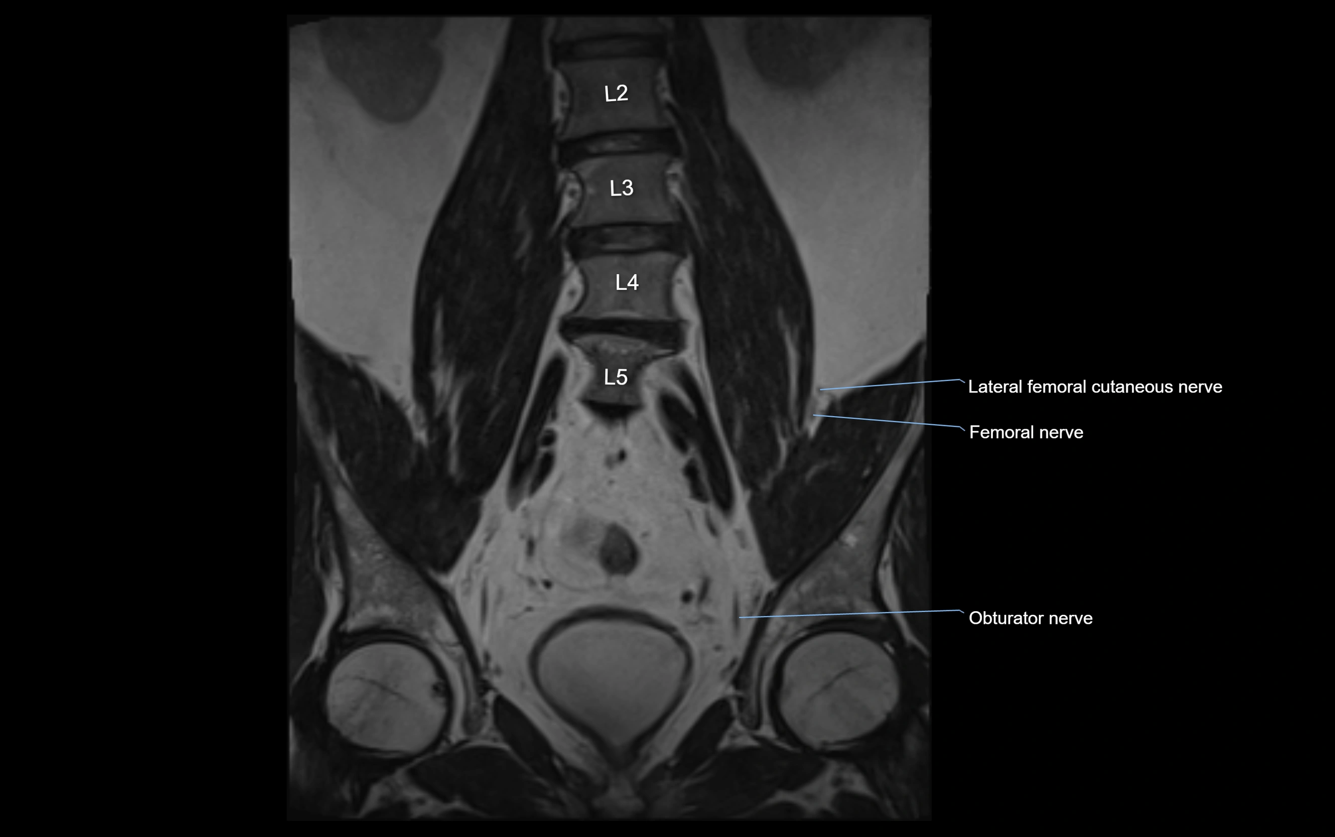 MR lumbosacral plexus cross sectional anatomy 3T  radiology  image-img-09001-00018.webp
